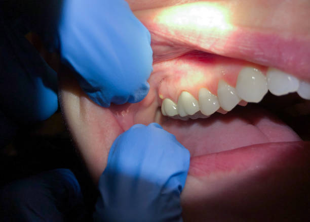 Best Knocked-Out Tooth (Avulsed Tooth) Treatment in Berry College, GA