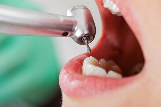 Best Knocked-Out Tooth (Avulsed Tooth) Treatment in Berry College, GA